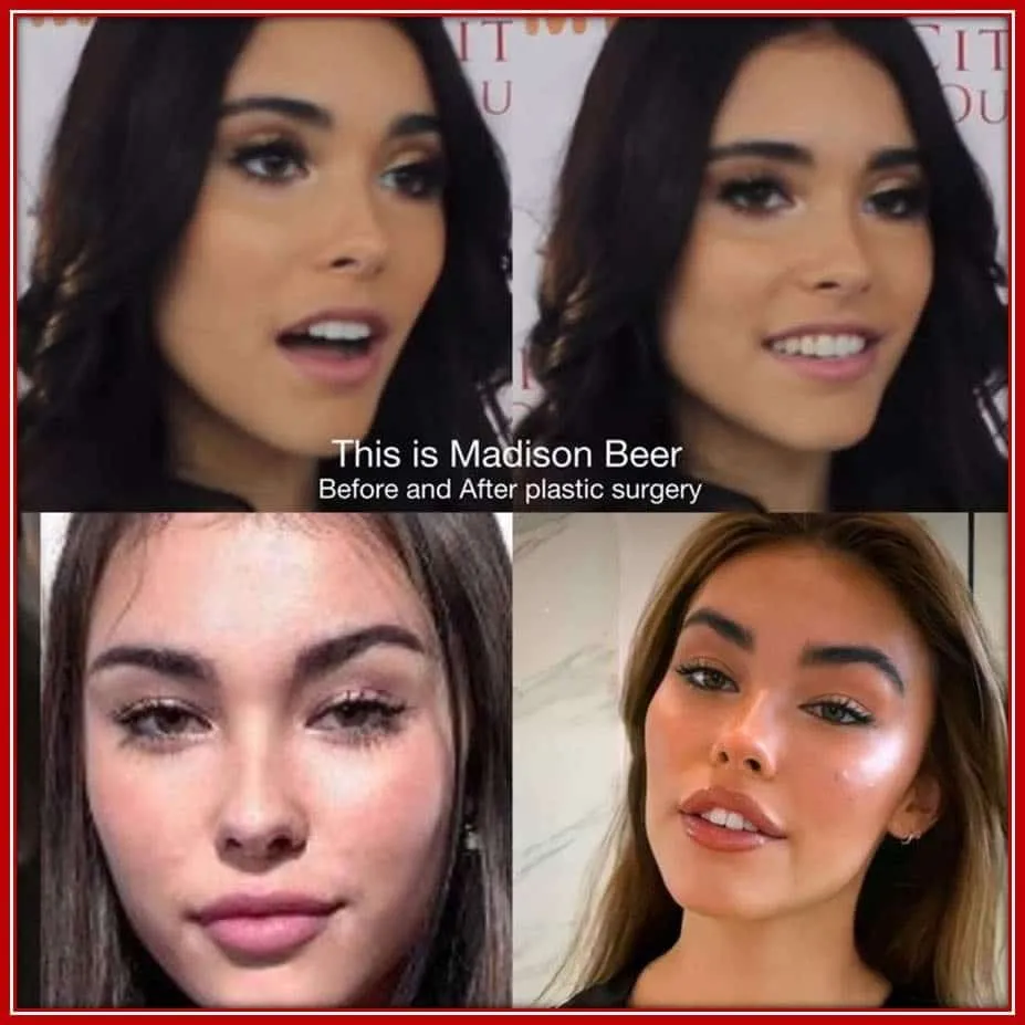See Madison Beer's Before and After plastic surgery. Do you notice any difference?